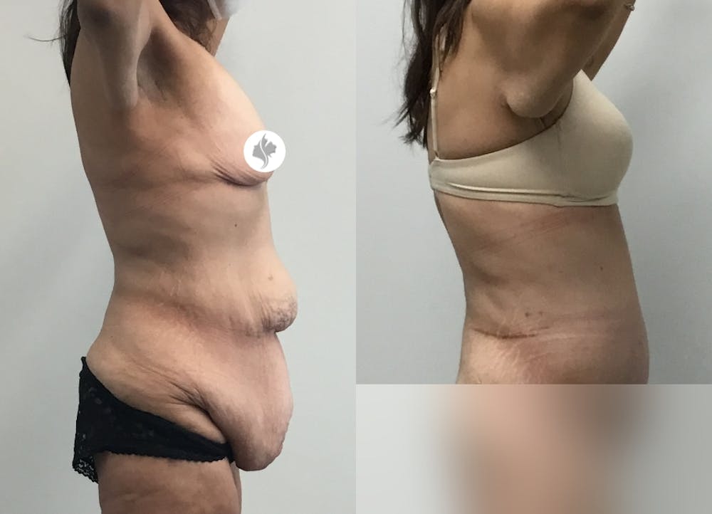 This is one of our beautiful post-bariatric body contouring patient #43