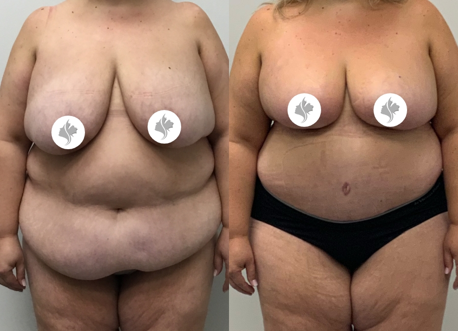 This is one of our beautiful tummy tuck patient 80