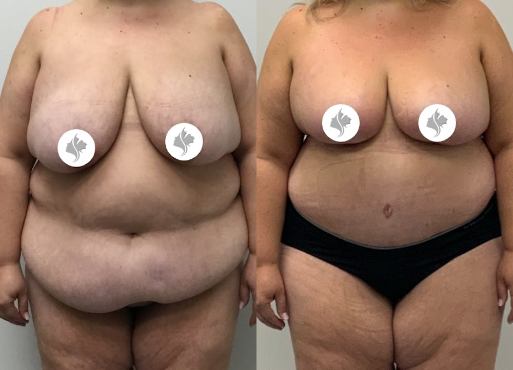 This is one of our beautiful post-bariatric body contouring patient #44