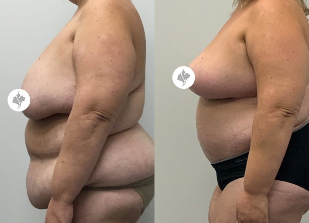 This is one of our beautiful post-bariatric body contouring patient #44