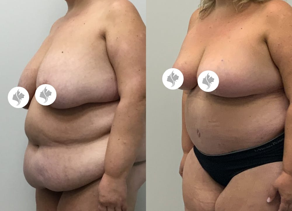 This is one of our beautiful post-bariatric body contouring patient #44