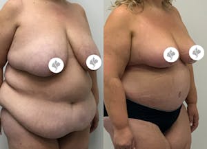 This is one of our beautiful post-bariatric body contouring patient 44