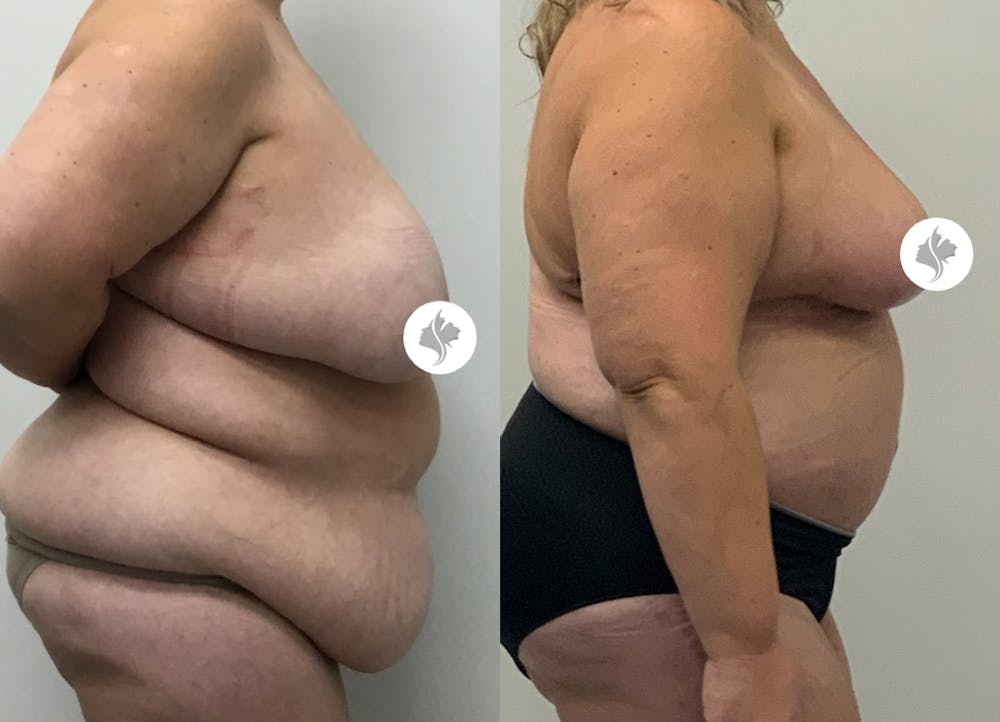 This is one of our beautiful tummy tuck patient #76