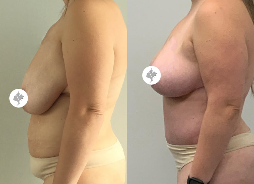 This is one of our beautiful post-bariatric body contouring patient #45