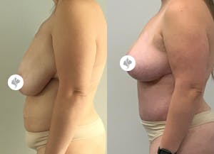This is one of our beautiful tummy tuck patient 77