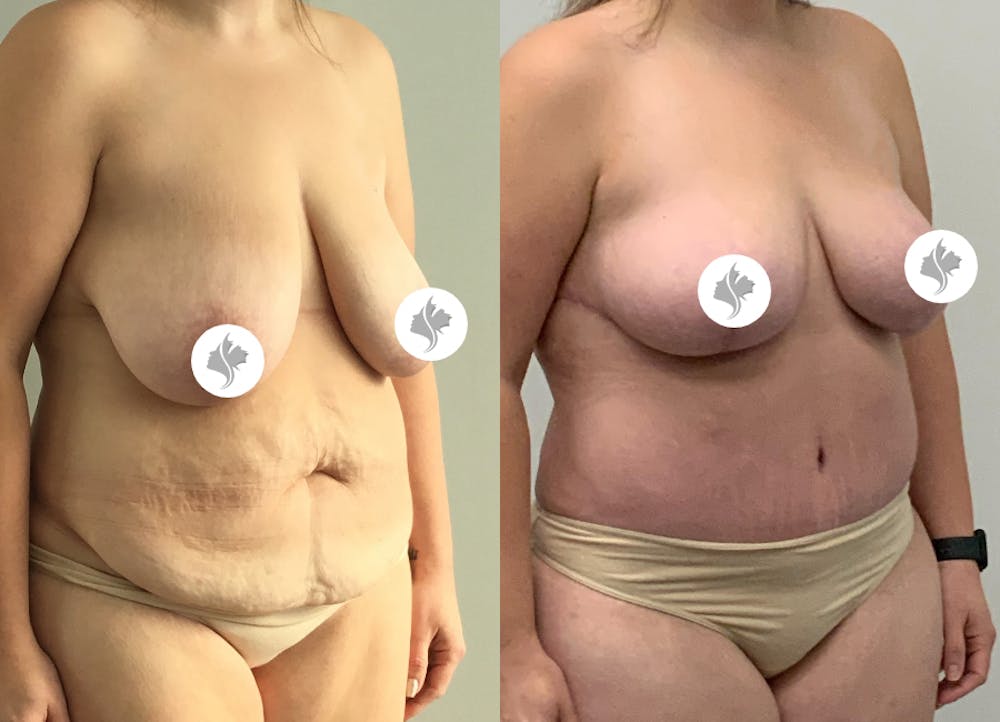 This is one of our beautiful tummy tuck patient #81