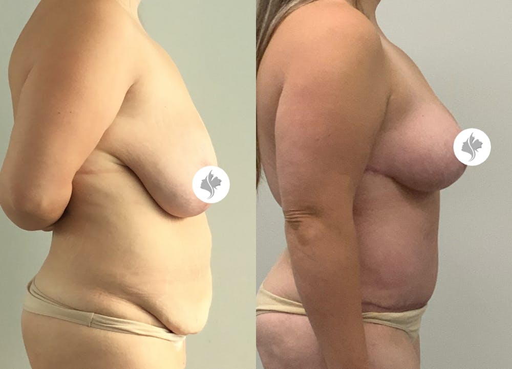 This is one of our beautiful post-bariatric body contouring patient #45