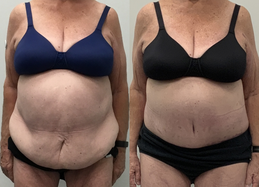 This is one of our beautiful post-bariatric body contouring patient 46