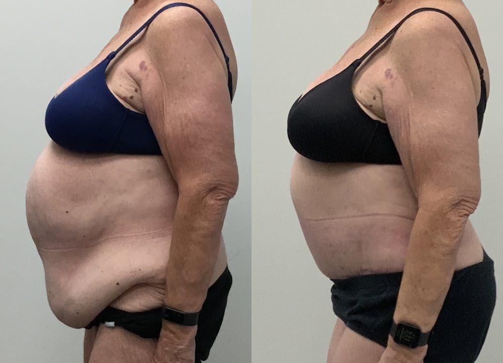 This is one of our beautiful post-bariatric body contouring patient #46