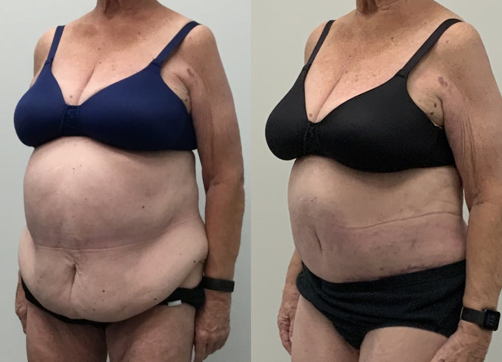 This is one of our beautiful post-bariatric body contouring patient #46