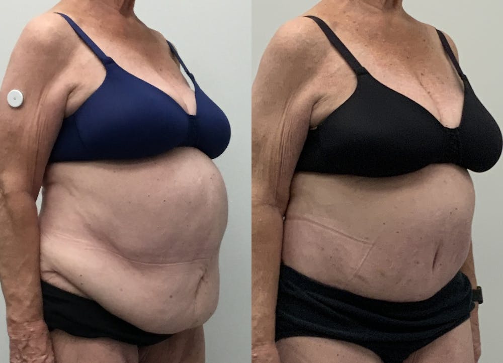 This is one of our beautiful post-bariatric body contouring patient #46