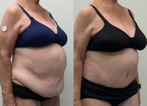 This is one of our beautiful post-bariatric body contouring patient 46
