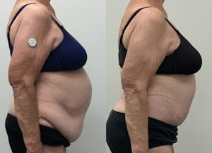 This is one of our beautiful post-bariatric body contouring patient 46