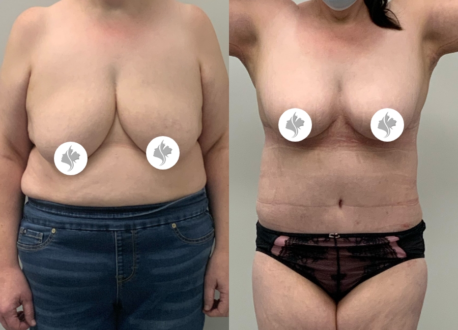 This is one of our beautiful post-bariatric body contouring patient 38