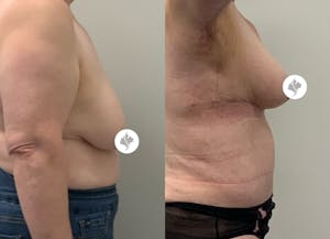 This is one of our beautiful tummy tuck patient 79