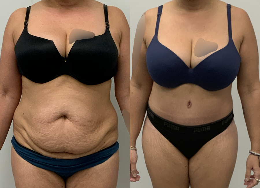 This is one of our beautiful tummy tuck patient 80