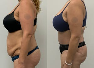 This is one of our beautiful tummy tuck patient 80
