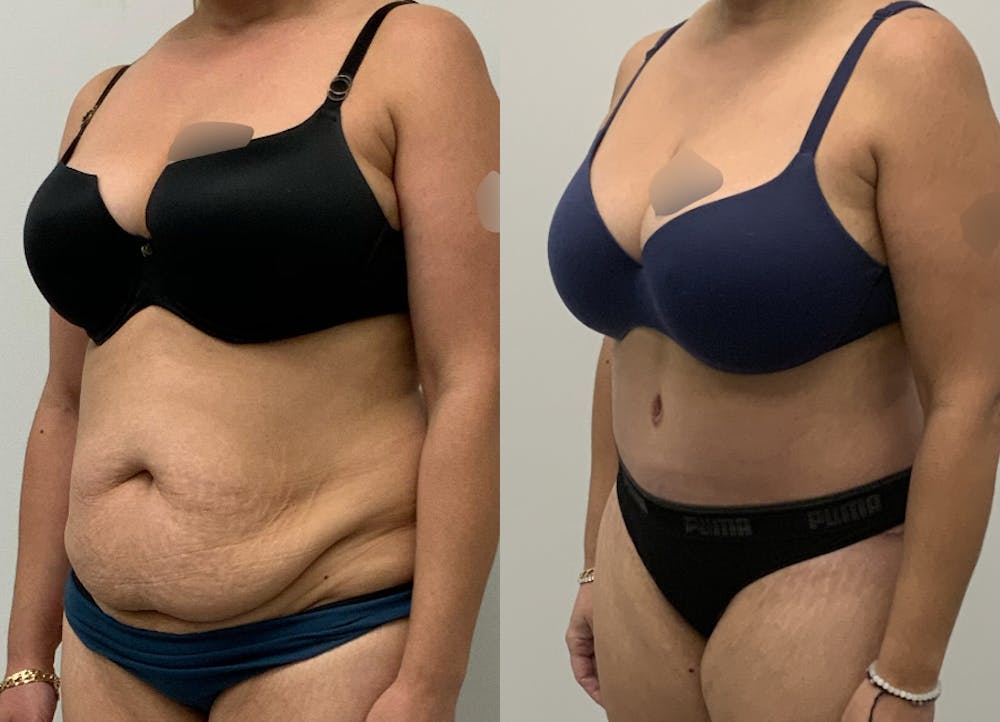 This is one of our beautiful tummy tuck patient #80