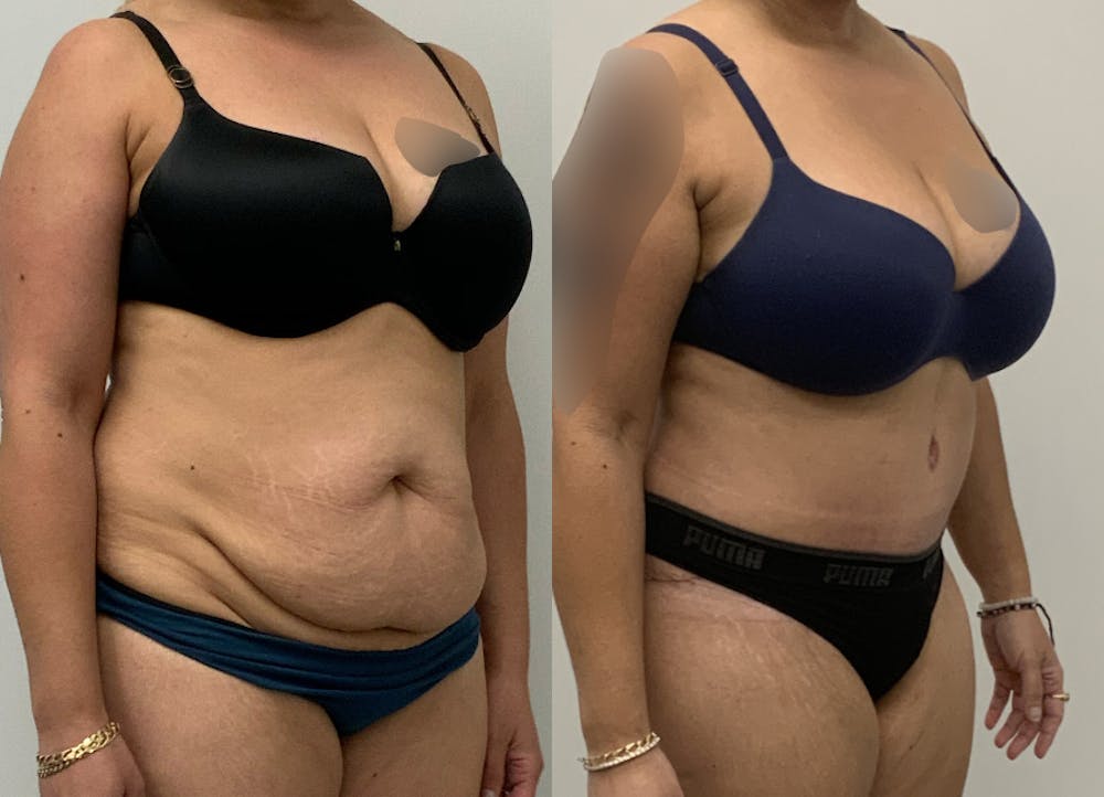 This is one of our beautiful tummy tuck patient #84