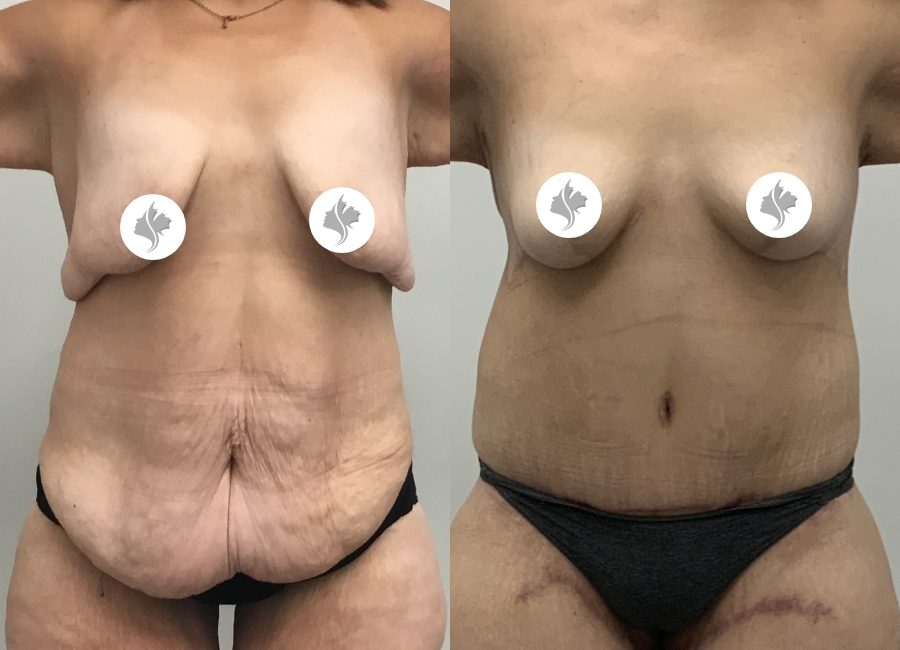 This is one of our beautiful tummy tuck patient 81