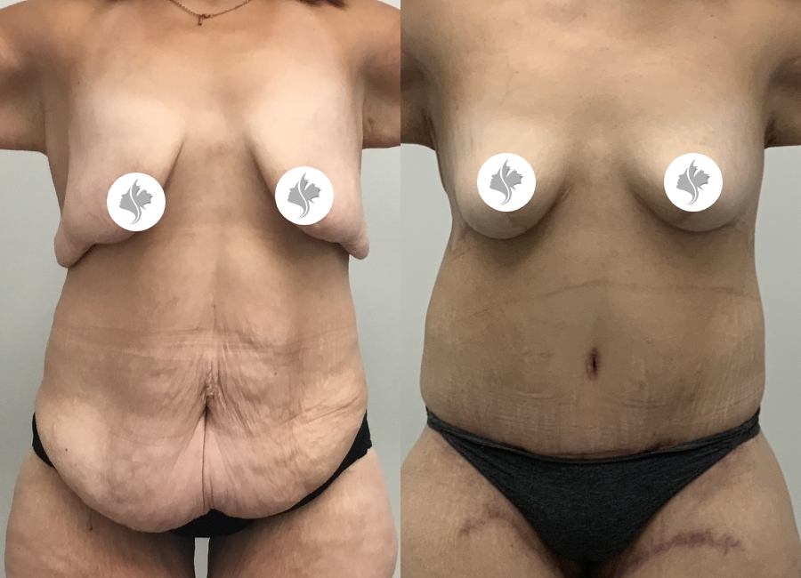 This is one of our beautiful tummy tuck patient 85