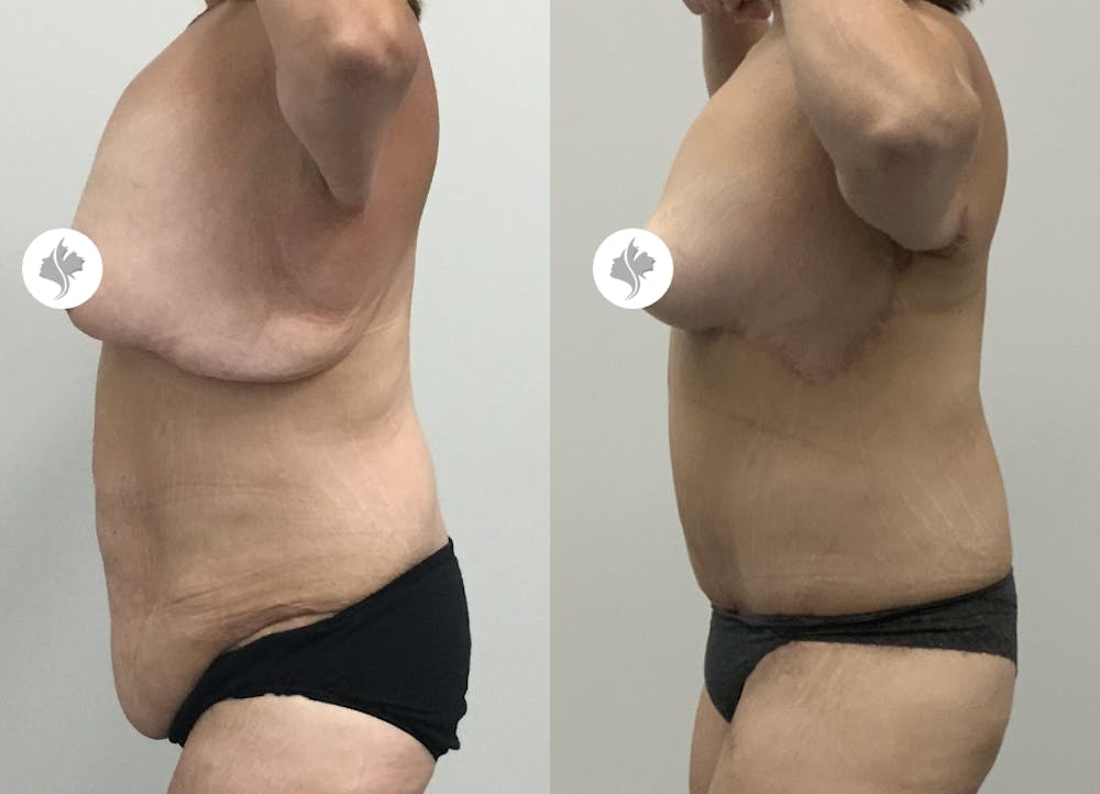 This is one of our beautiful tummy tuck patient #81