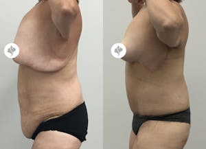 This is one of our beautiful tummy tuck patient 81