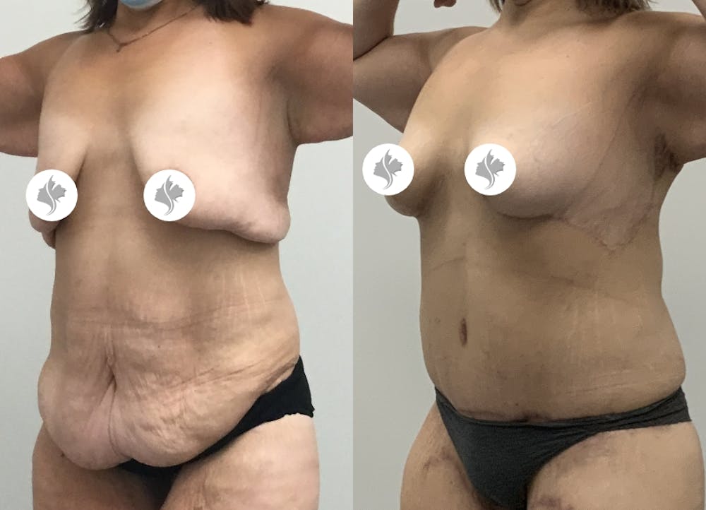 This is one of our beautiful tummy tuck patient #81