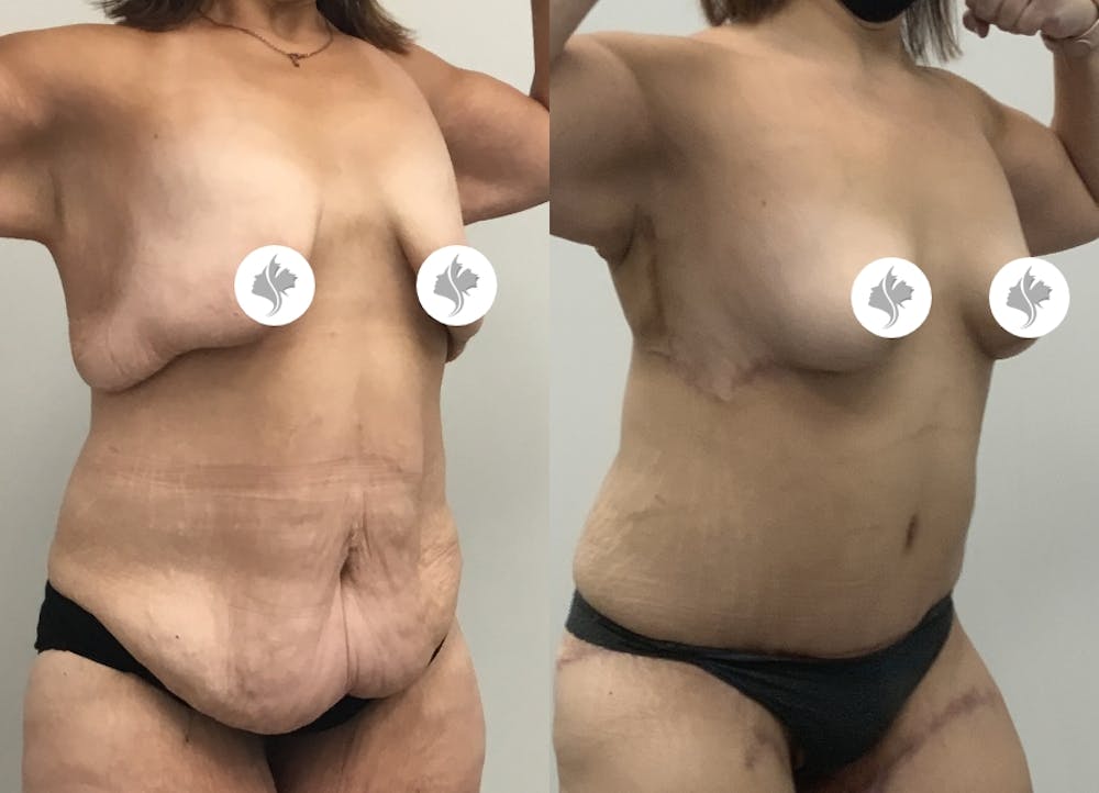 This is one of our beautiful tummy tuck patient #81