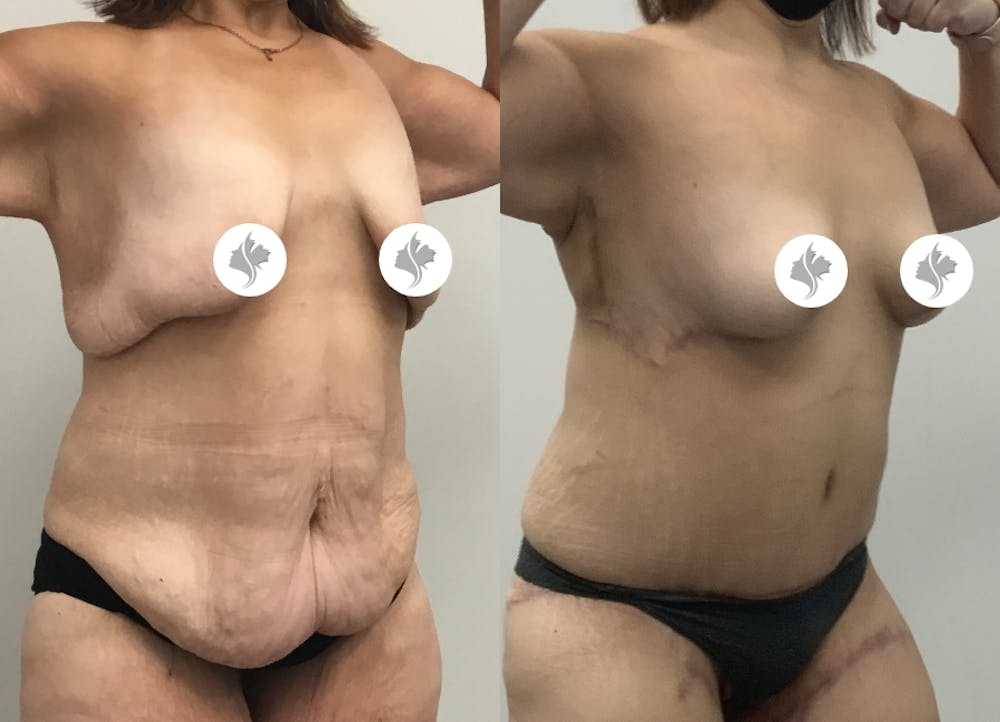 This is one of our beautiful post-bariatric body contouring patient #4