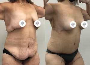 This is one of our beautiful tummy tuck patient 81
