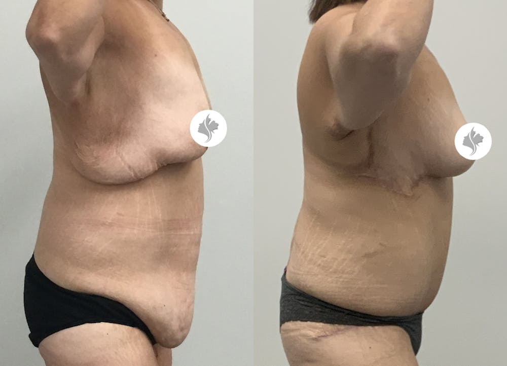 This is one of our beautiful tummy tuck patient #81
