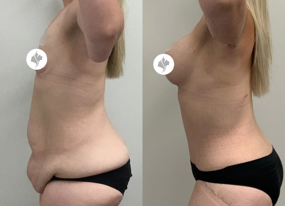 This is one of our beautiful post-bariatric body contouring patient #1