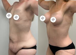 This is one of our beautiful post-bariatric body contouring patient 1