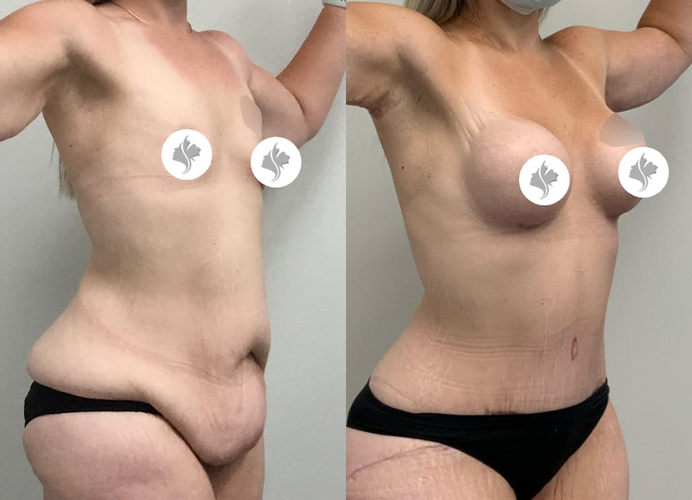 This is one of our beautiful tummy tuck patient #86