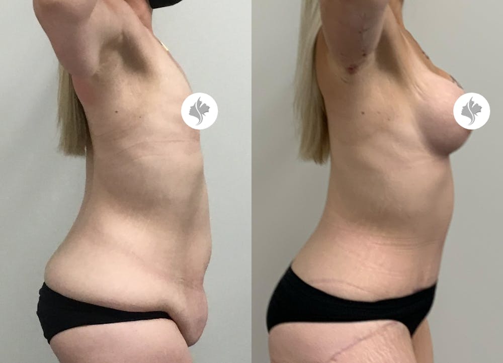 This is one of our beautiful tummy tuck patient #86