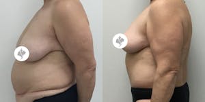 This is one of our beautiful breast reduction patient 74