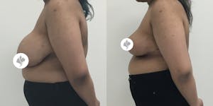 This is one of our beautiful breast reduction patient 10