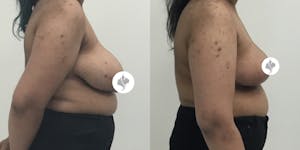 This is one of our beautiful breast reduction patient 10