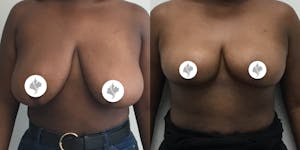 This is one of our beautiful breast reduction patient 75