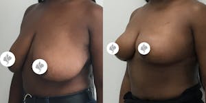 This is one of our beautiful breast reduction patient 75