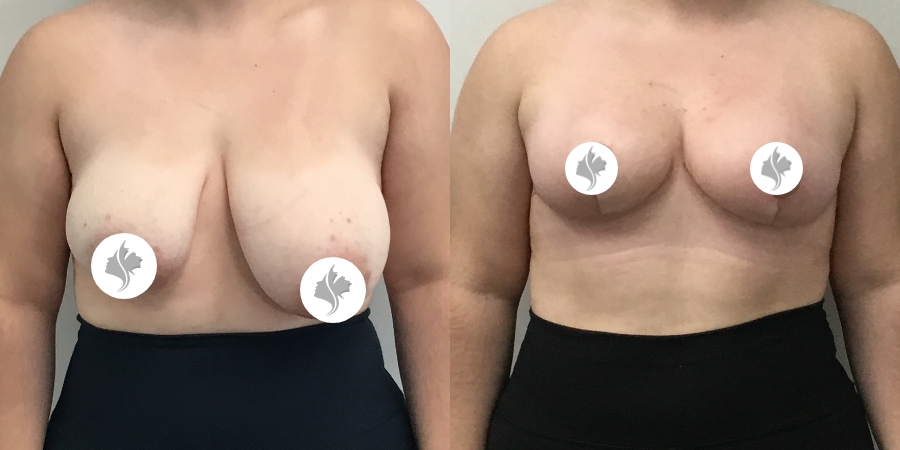 This is one of our beautiful breast asymmetry correction patient 7