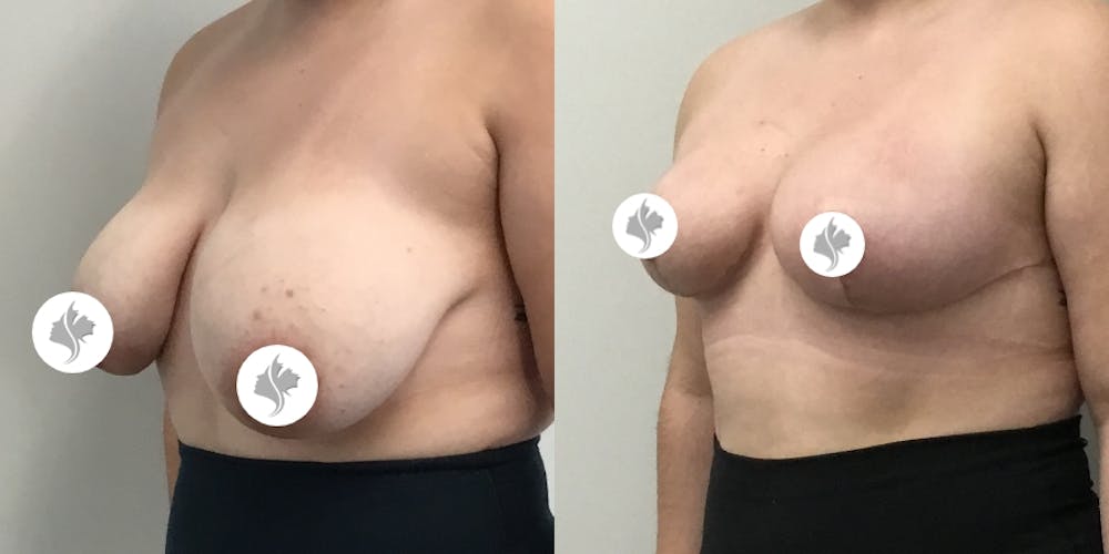 This is one of our beautiful breast asymmetry correction patient #7