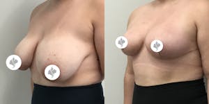 This is one of our beautiful breast asymmetry correction patient 7