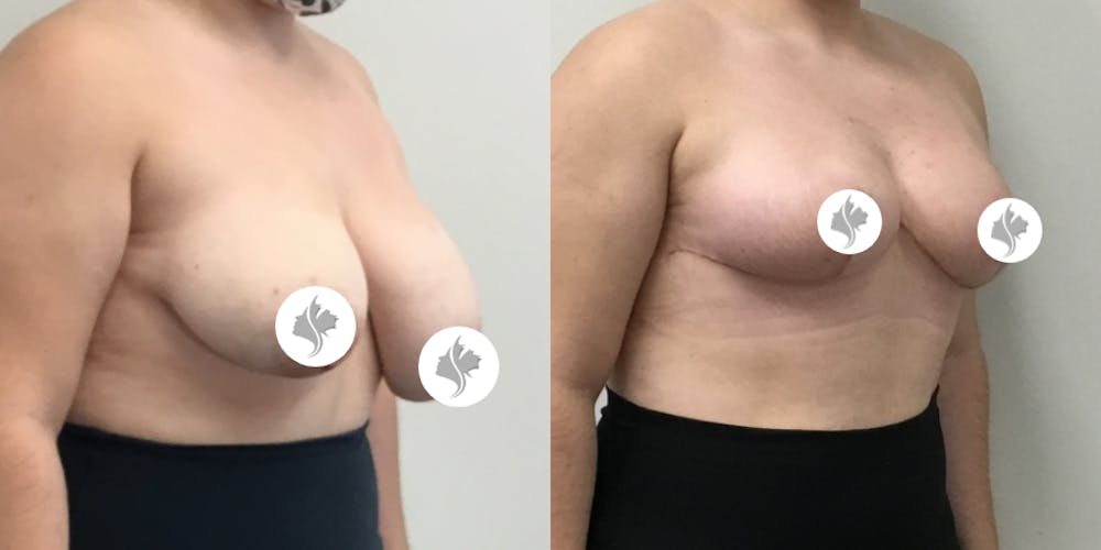This is one of our beautiful breast asymmetry correction patient #7