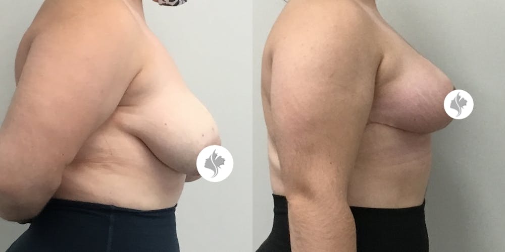 This is one of our beautiful breast asymmetry correction patient #7