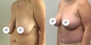 This is one of our beautiful breast reduction patient 12