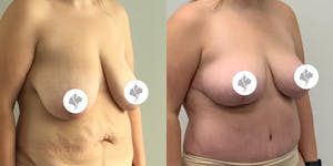 This is one of our beautiful breast reduction patient 12