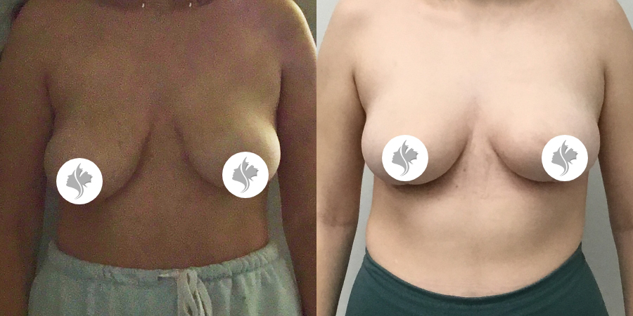 This is one of our beautiful breast asymmetry correction patient 15