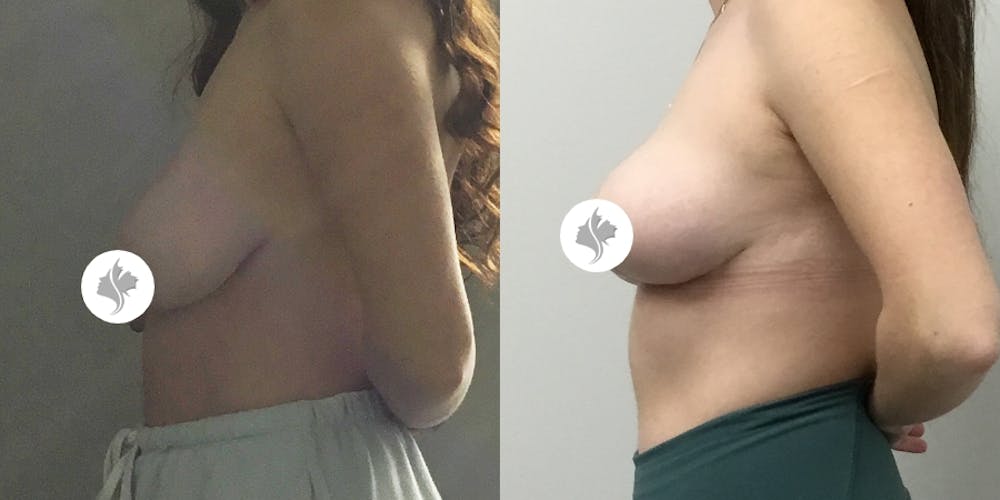 This is one of our beautiful breast asymmetry correction patient #15